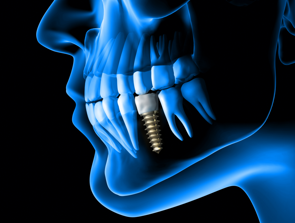 The Fundamentals of Implant Dentistry